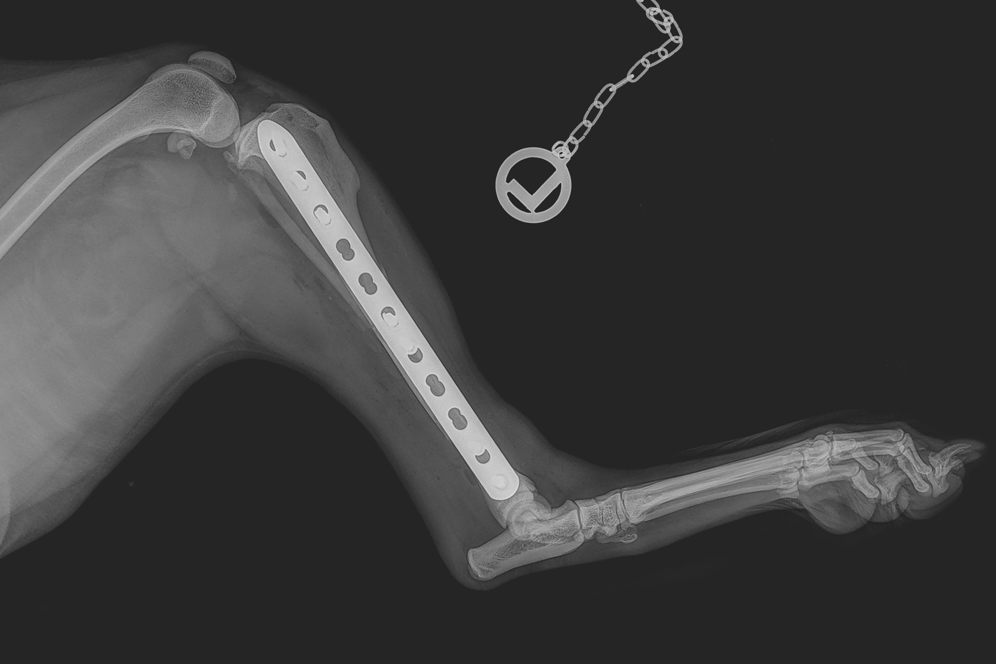 Zweifache Tibia-Fraktur: nach der Operation