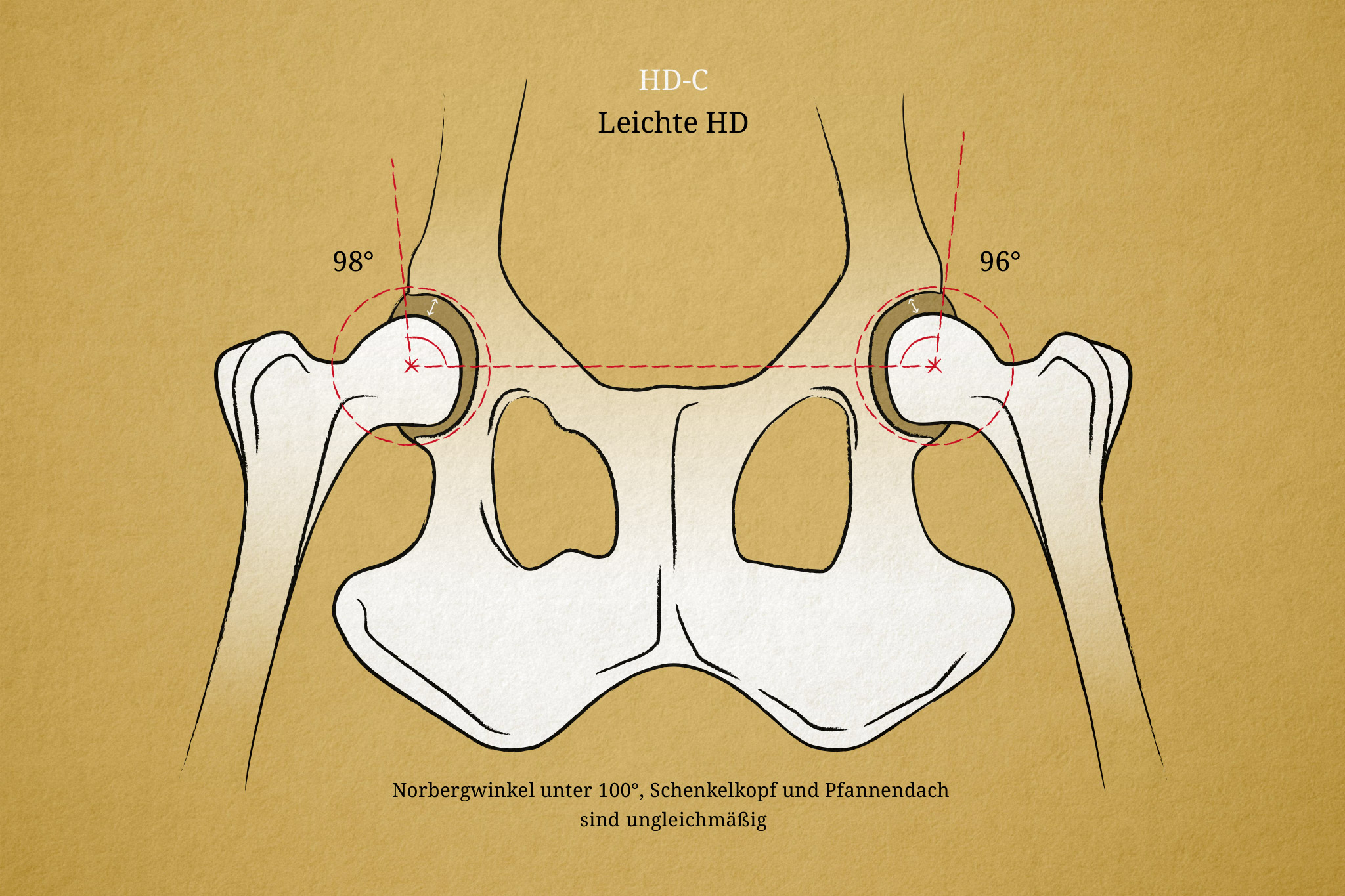 Hüftgelenksdysplasie Hund Illustration, HD-C, Norbergwinkel