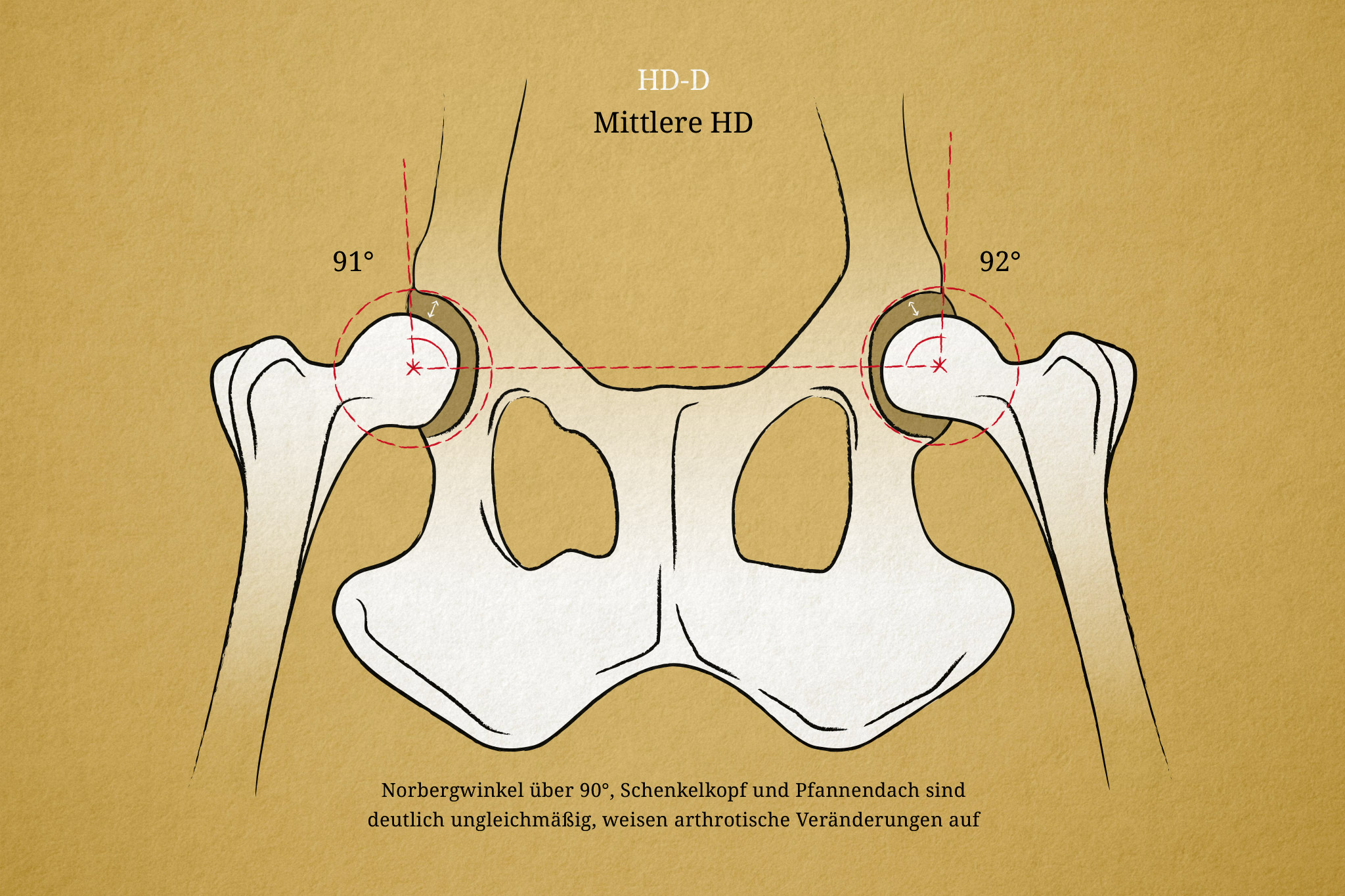 Hüftgelenksdysplasie Hund Illustration, HD-D, Norbergwinkel